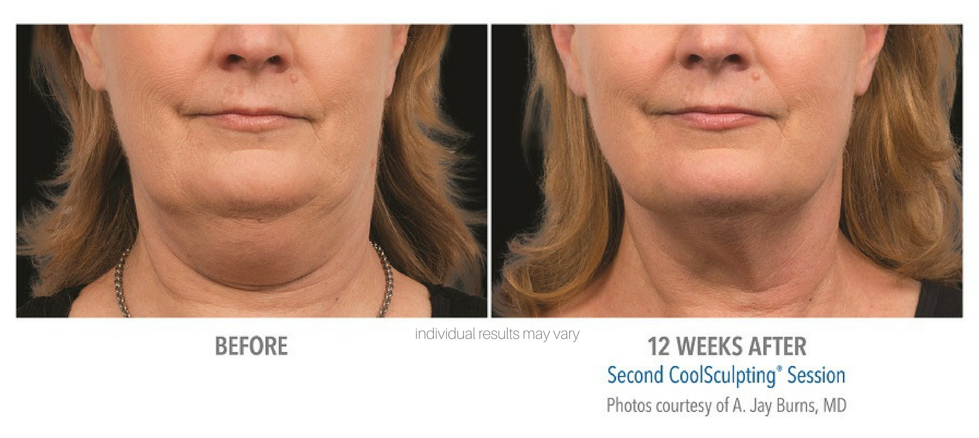 coolsculpting-before-and-after-1