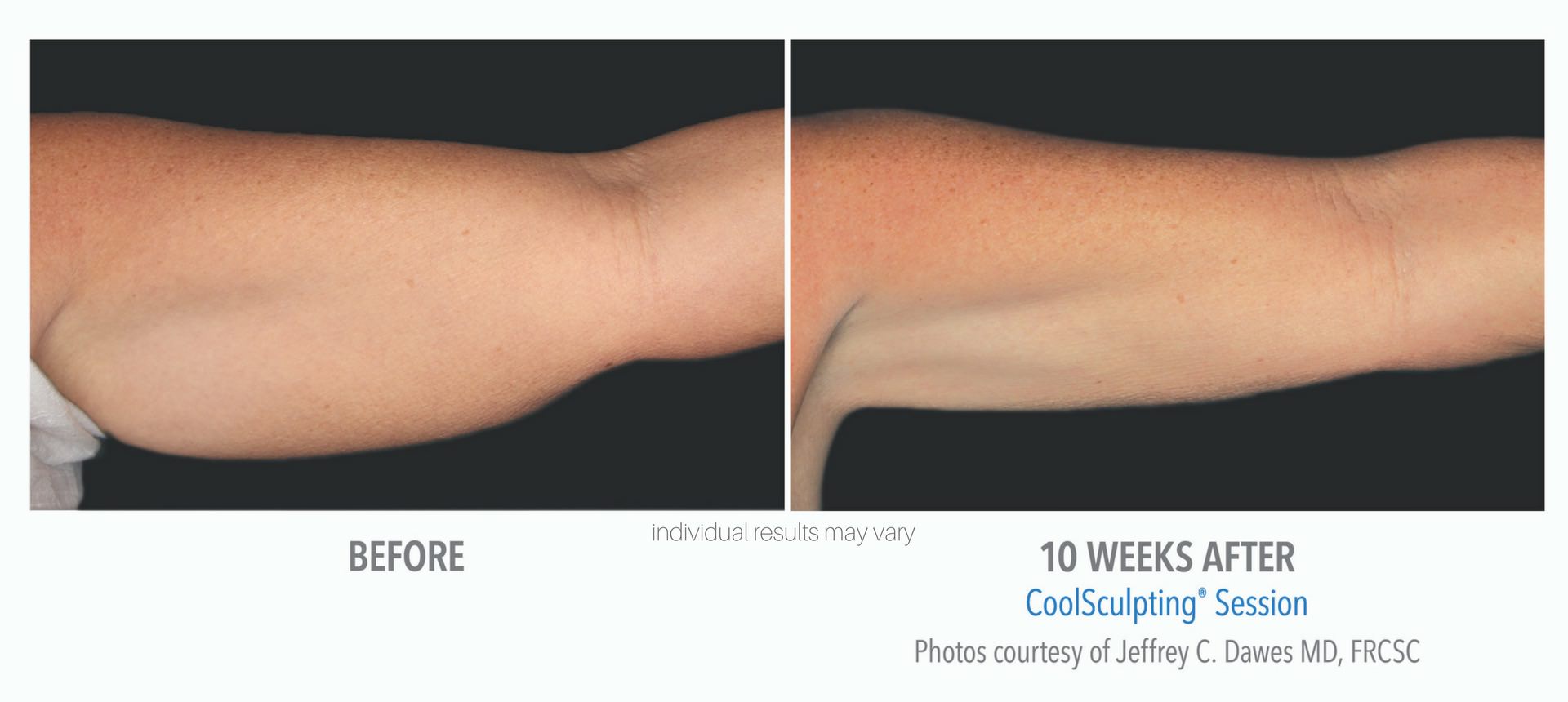 coolsculpting-before-and-after-2