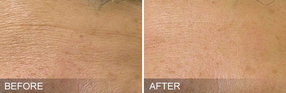 hydrafacial-before-and-after-center-for-medical-aesthetics-providence-ri-01