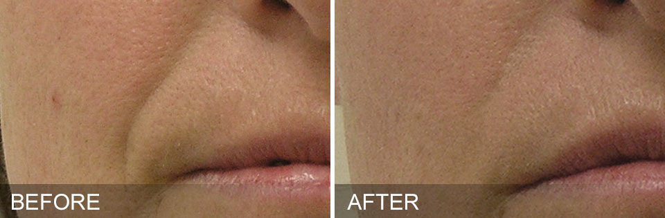 hydrafacial-before-and-after-center-for-medical-aesthetics-providence-ri-02