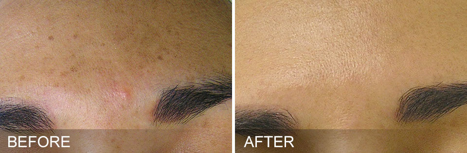 hydrafacial-before-and-after-center-for-medical-aesthetics-providence-ri-03