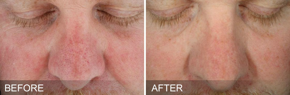 hydrafacial-before-and-after-center-for-medical-aesthetics-providence-ri-05