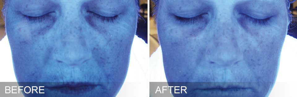hydrafacial-before-and-after-center-for-medical-aesthetics-providence-ri-06