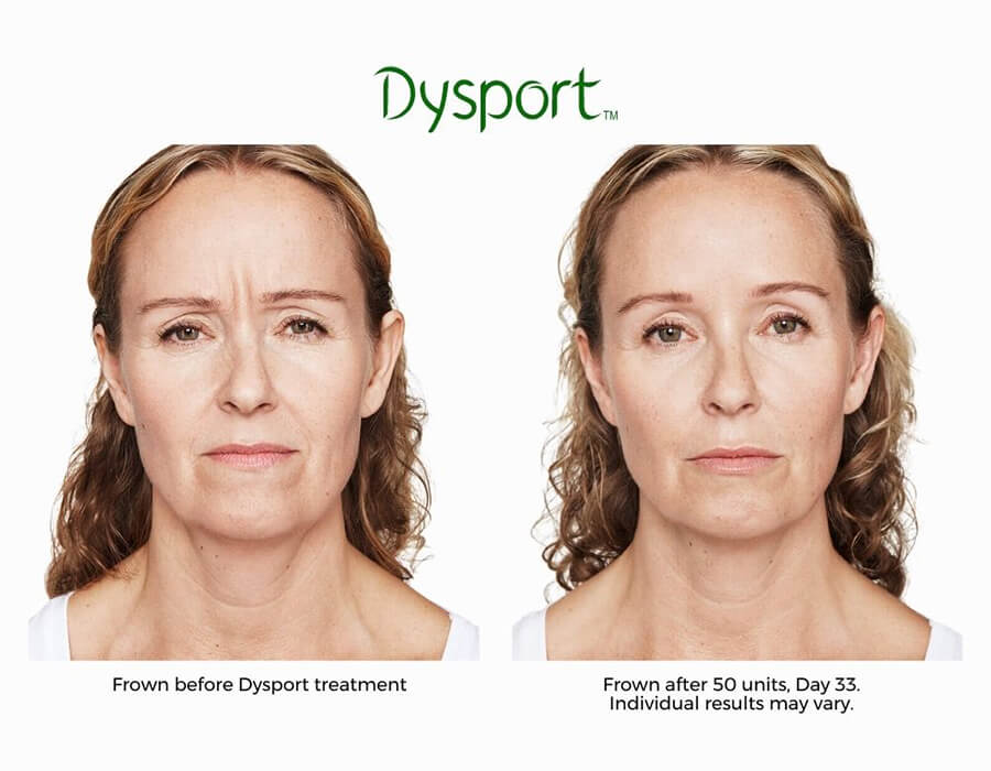 center-for-medical-aesthetics-dysport-before-and-after-1-1