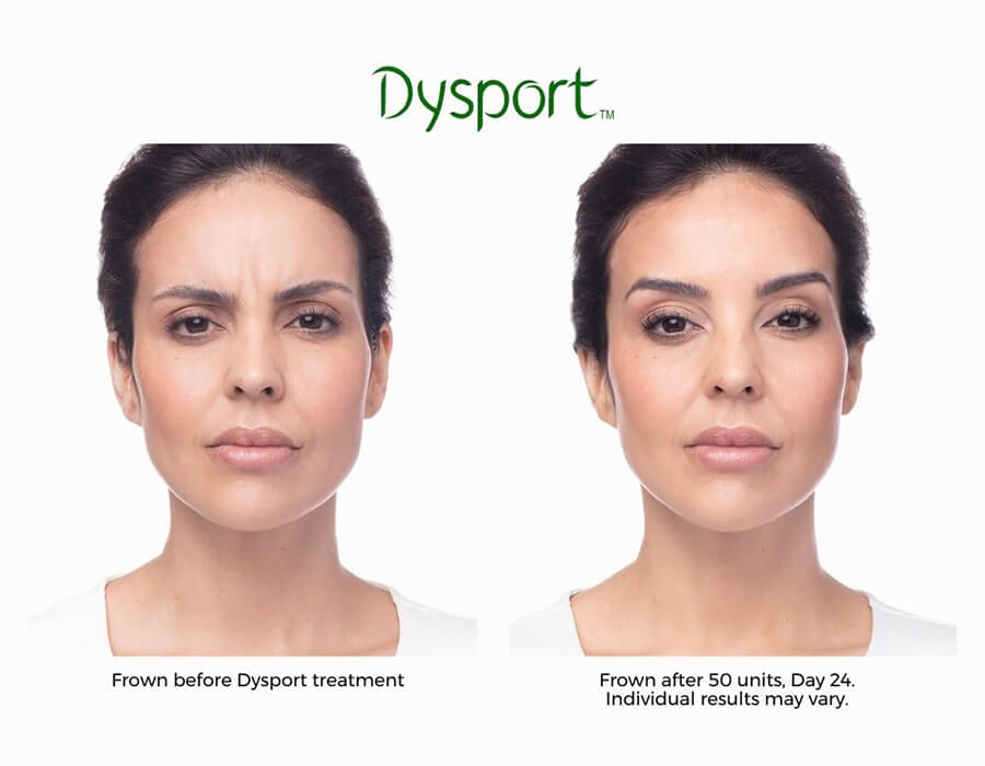 center-for-medical-aesthetics-dysport-before-and-after-3-1