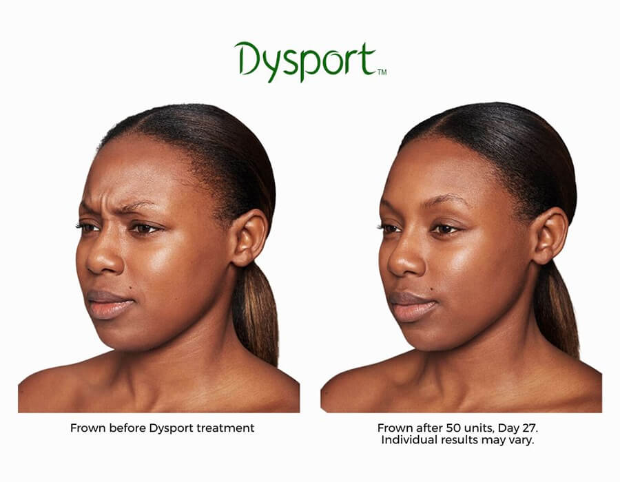 center_for_medical_aesthetics_-dysport-before-and-after-2_1