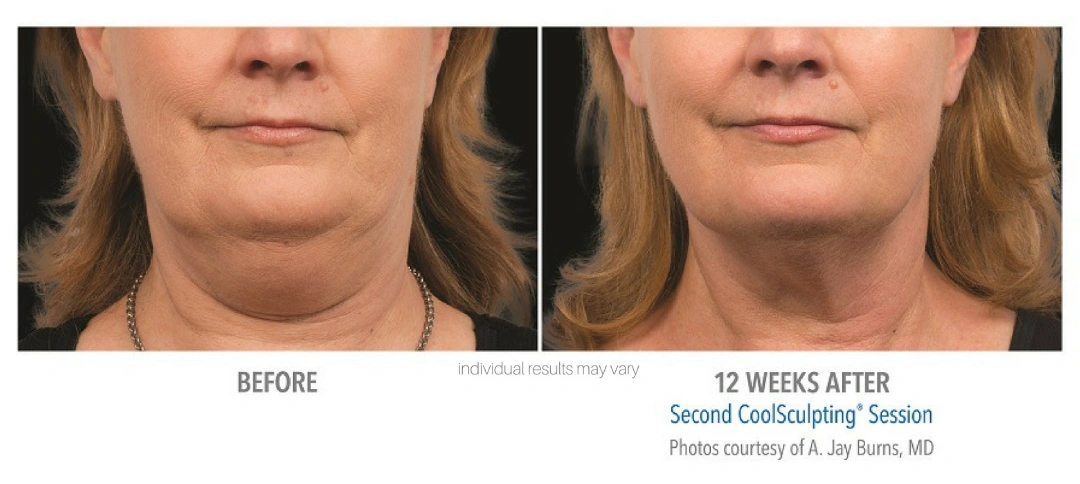 coolsculpting-before-and-after-1-center-for-medical-aesthetics-providence-ri