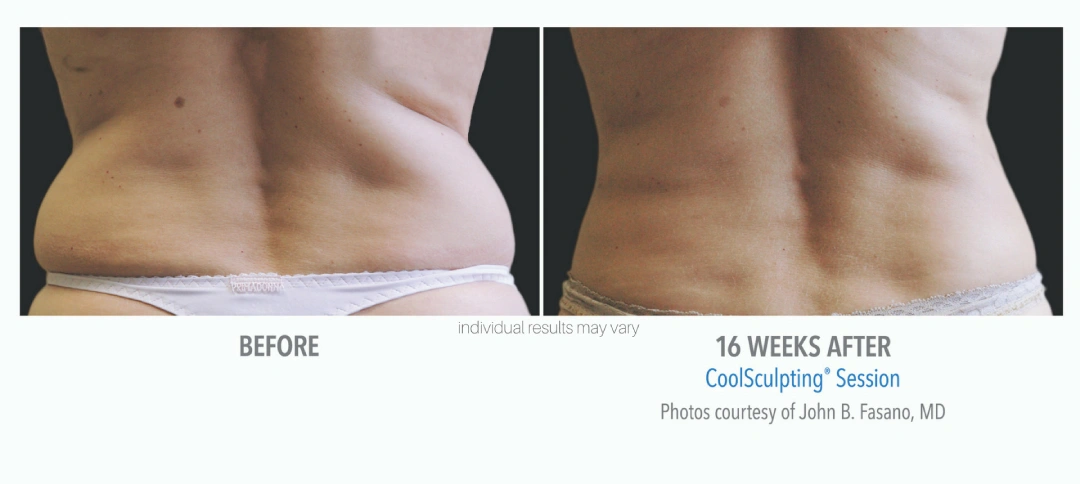 coolsculpting-before-and-after-4-center-for-medical-aesthetics-providence-ri