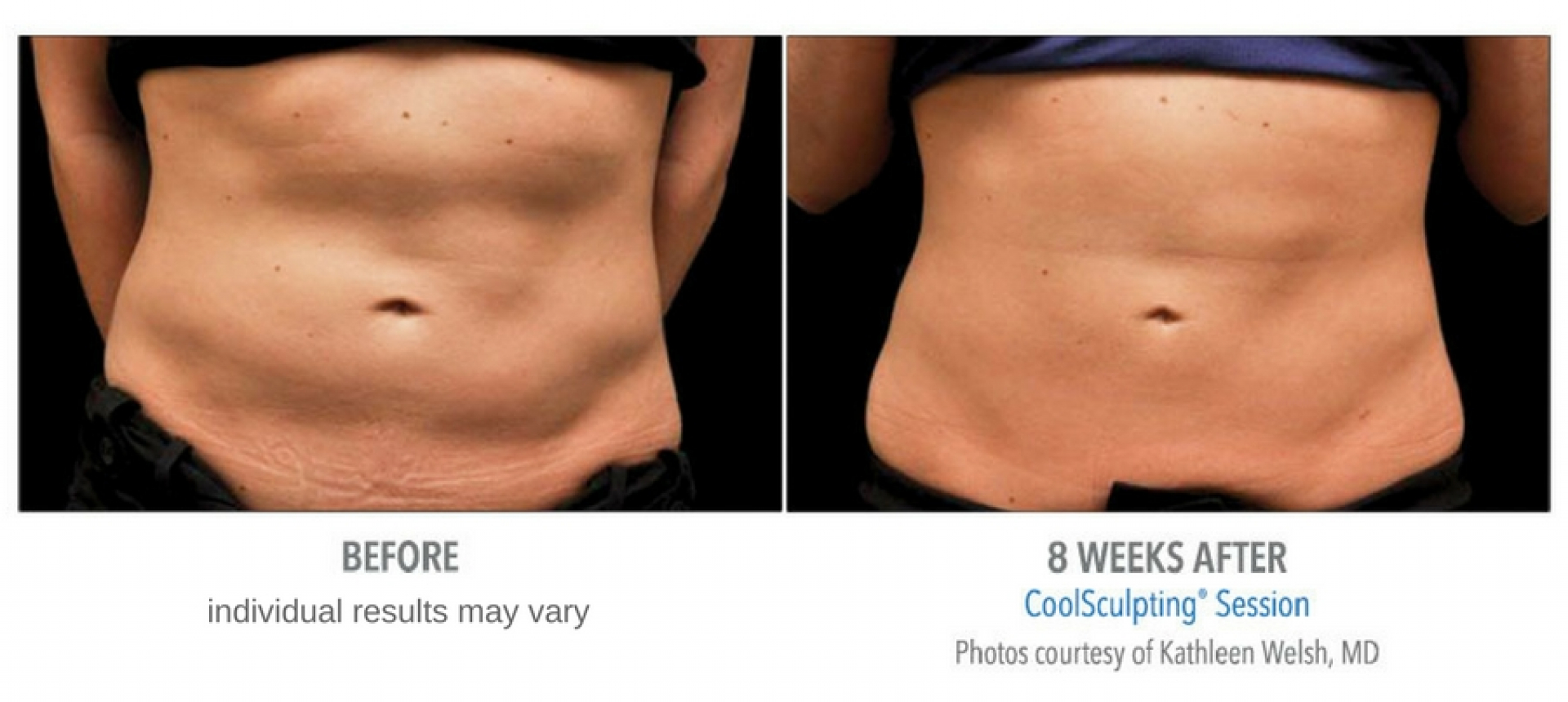 Coolsculpting Before and After Photos Center For Medical Aesthetics