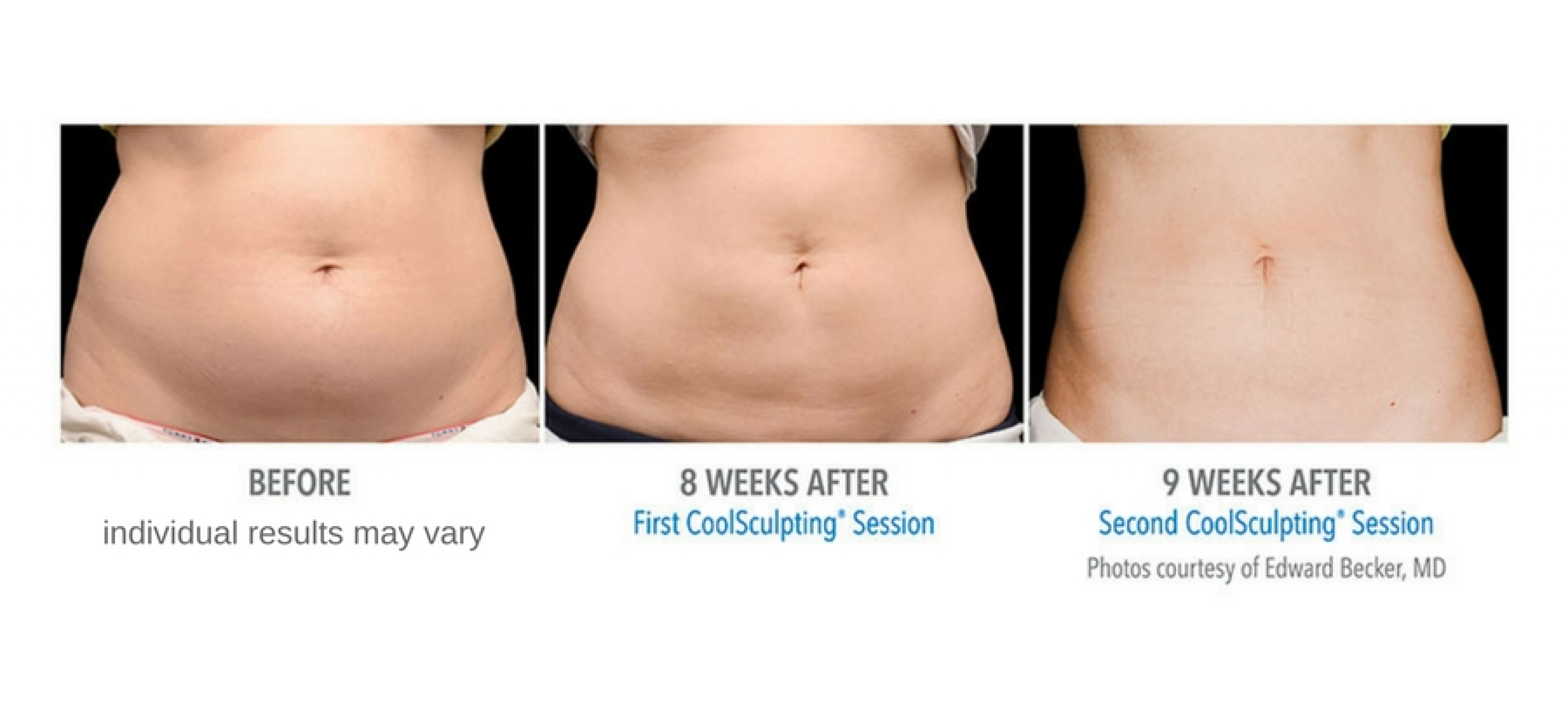 Coolsculpting Before and After Photos - Center For Medical Aesthetics