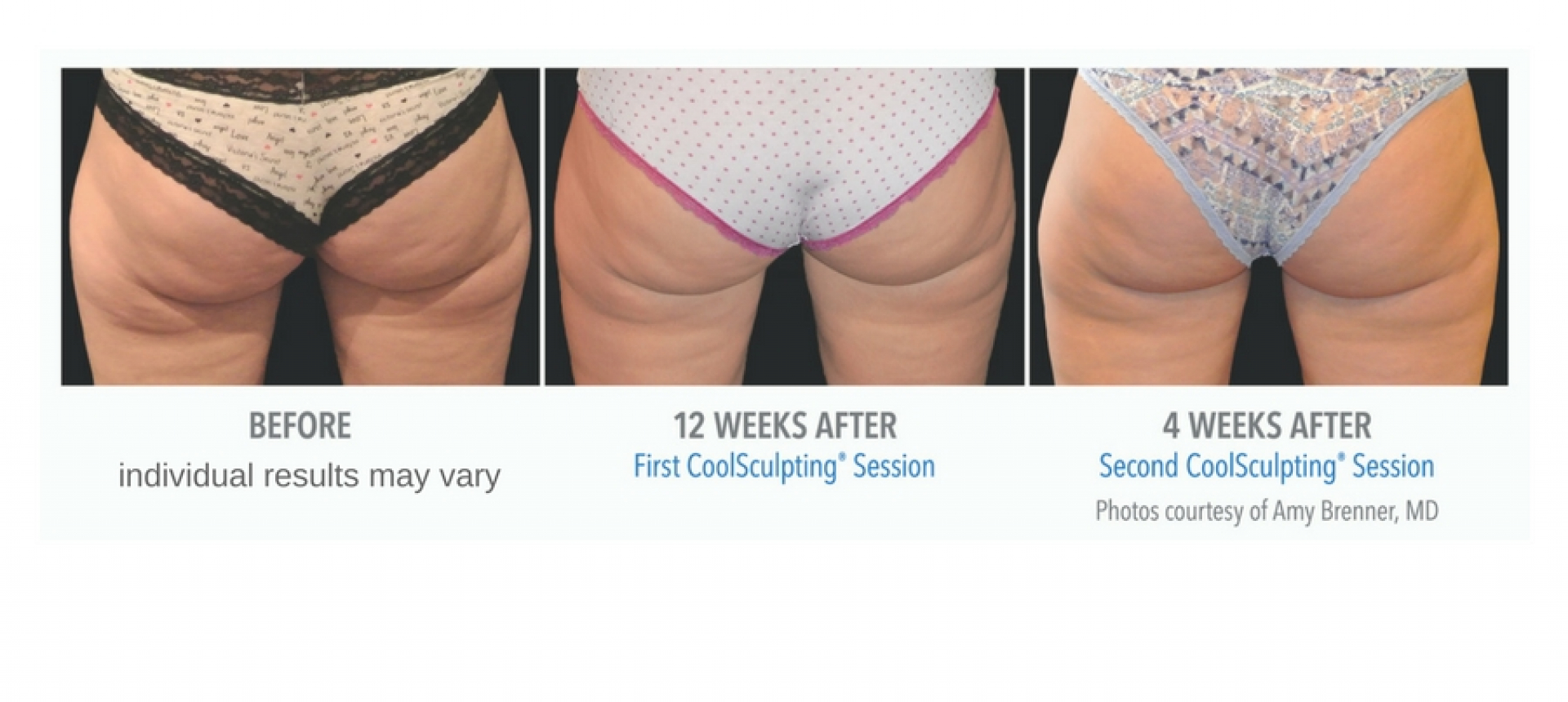 Coolsculpting Before And After Photos Center For Medical Aesthetics 