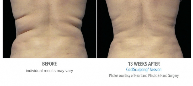 Coolsculpting Before and After Photos - Center For Medical Aesthetics