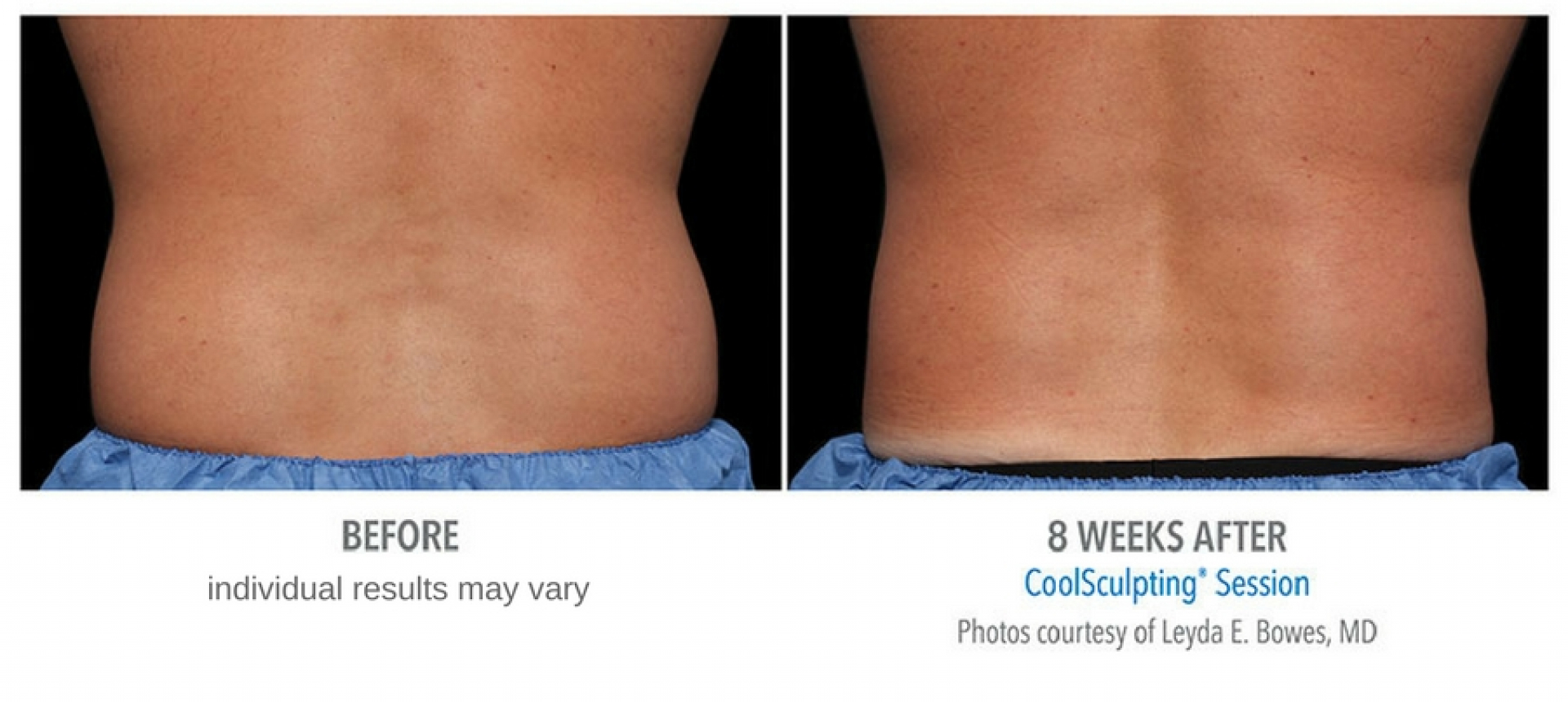 Coolsculpting Before And After Photos - Center For Medical Aesthetics